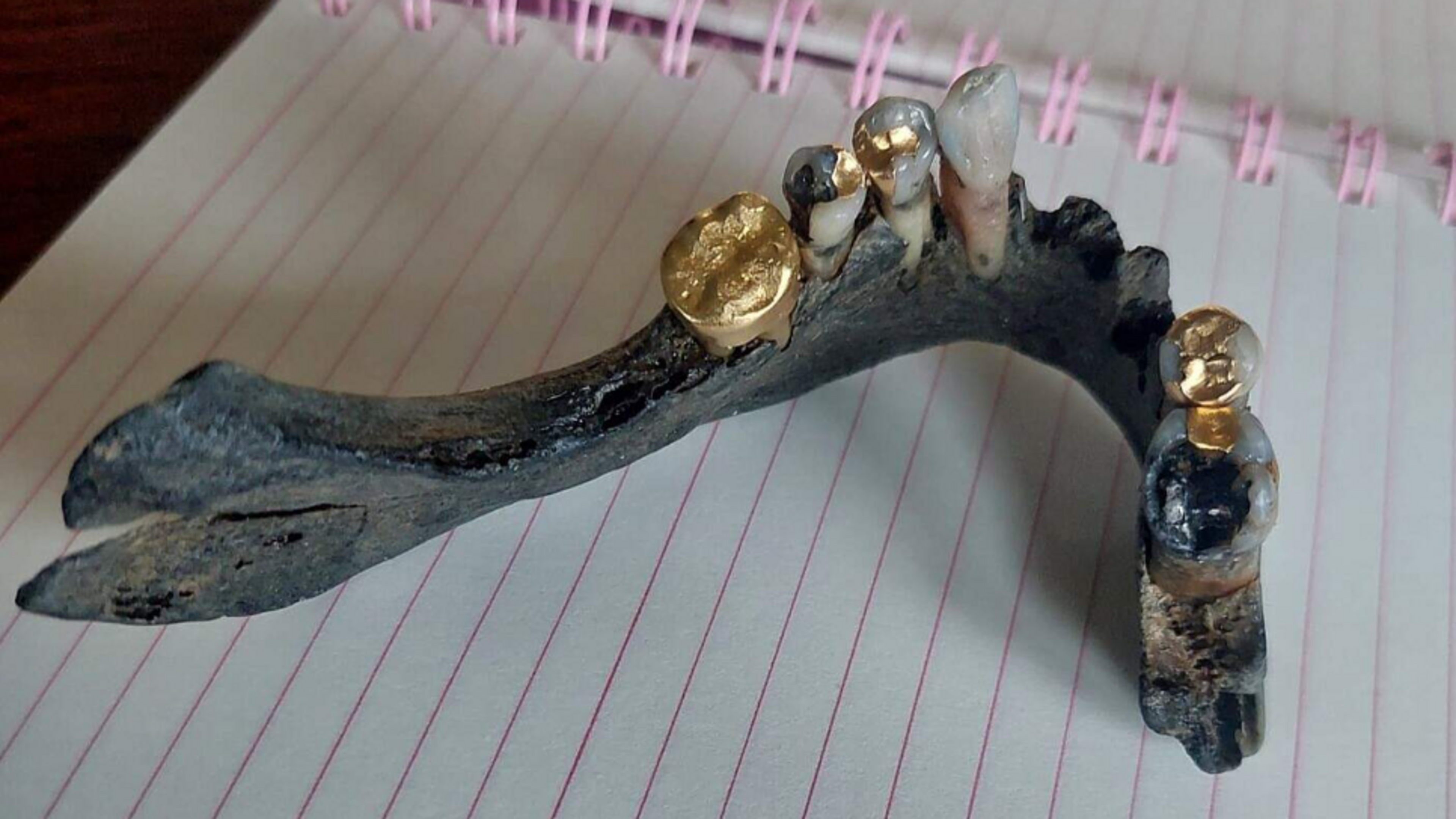 Jawbone with gold teeth belongs to a person who died after 1920